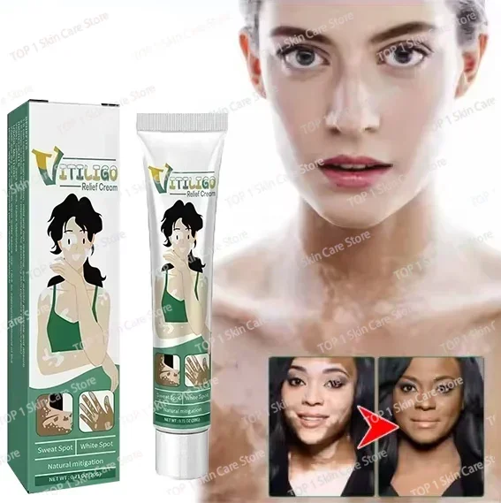 

Vitiligo Ointment Herbal Extract Remove Ringworm White Spot Removal Skin Vitiligo Eliminate Vitiligo Treatment Cream0903