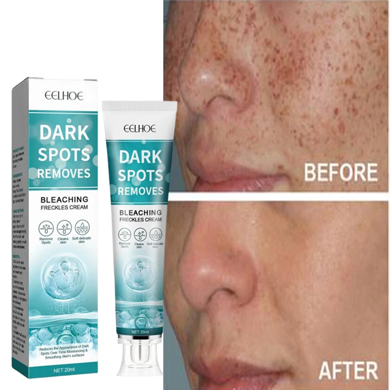 

Fade Dark Spot Corrector Skin Lightening Blemish Removal Serum Cream Fade Age Spots Whitening Freckles Face Cream Korea Skincare