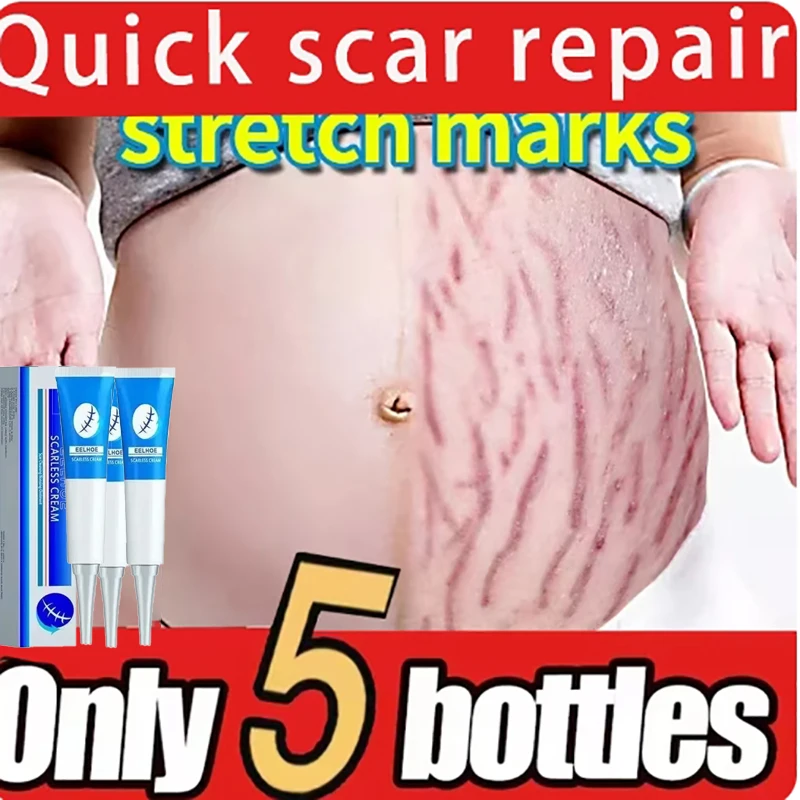 Eliminate Red White Old Stretch Marks Cream For Pregnancy Postpartum Skin Care