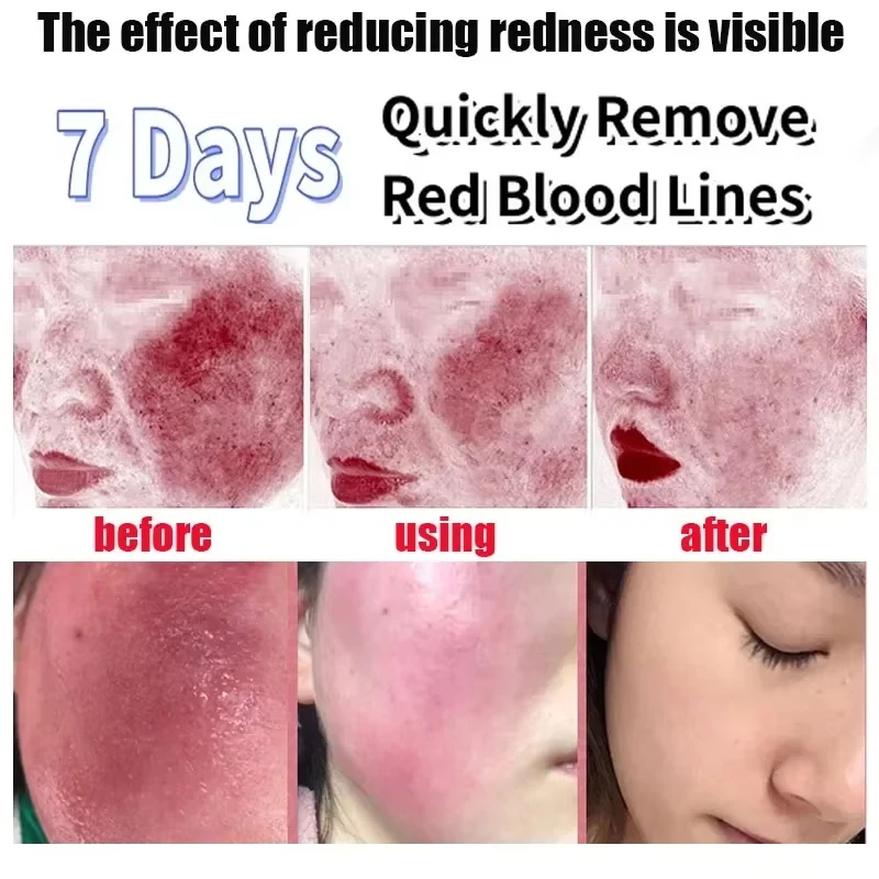 Instant Facial Redness Repair Cream Soothing Red Blood Rosacea Treatment Improve Sensitive Skin Moisturizing Skin Care Products