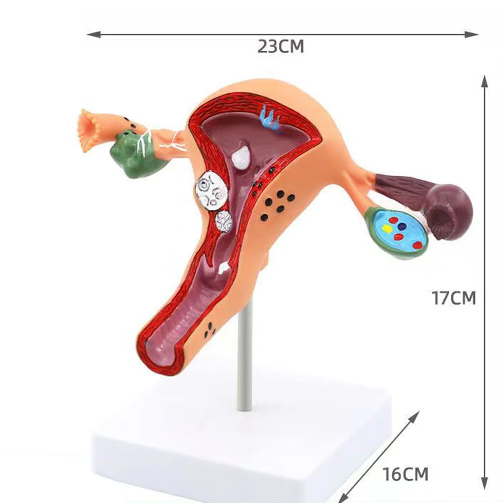 High Quality Human Female Uterus Ovary Disease Dissection Pathology Model Biology Teaching Aids Anatomy Lesion Uterus Dropship