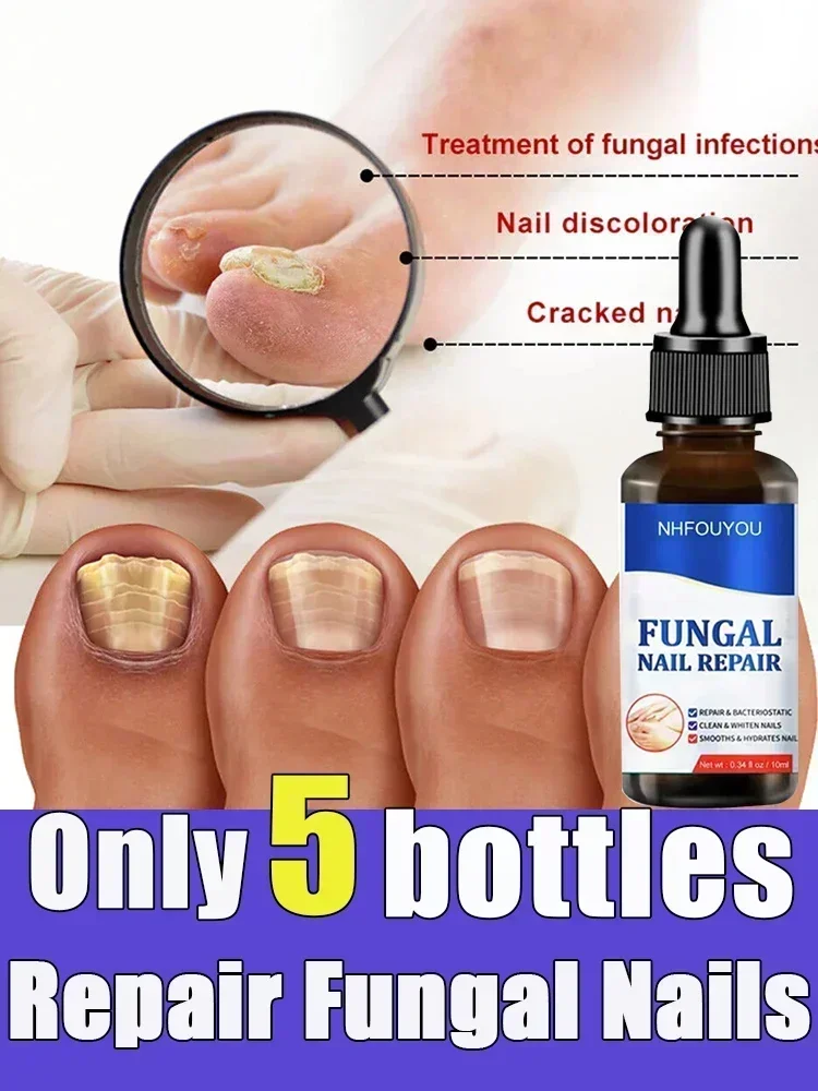 

NewToenail Nail Fungus Treatment Repair Fingernail Device Toenail Treatment for Foot Nail Fungus Essential Oil Onychomycosis Ca