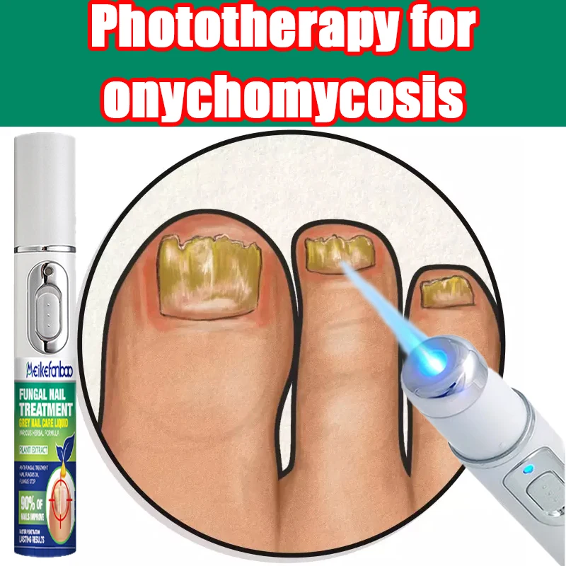 

Fungus nail laser pen helps to get rid of onychomycosis gray nail Painless and long-lasting sterilization anti-recurrence