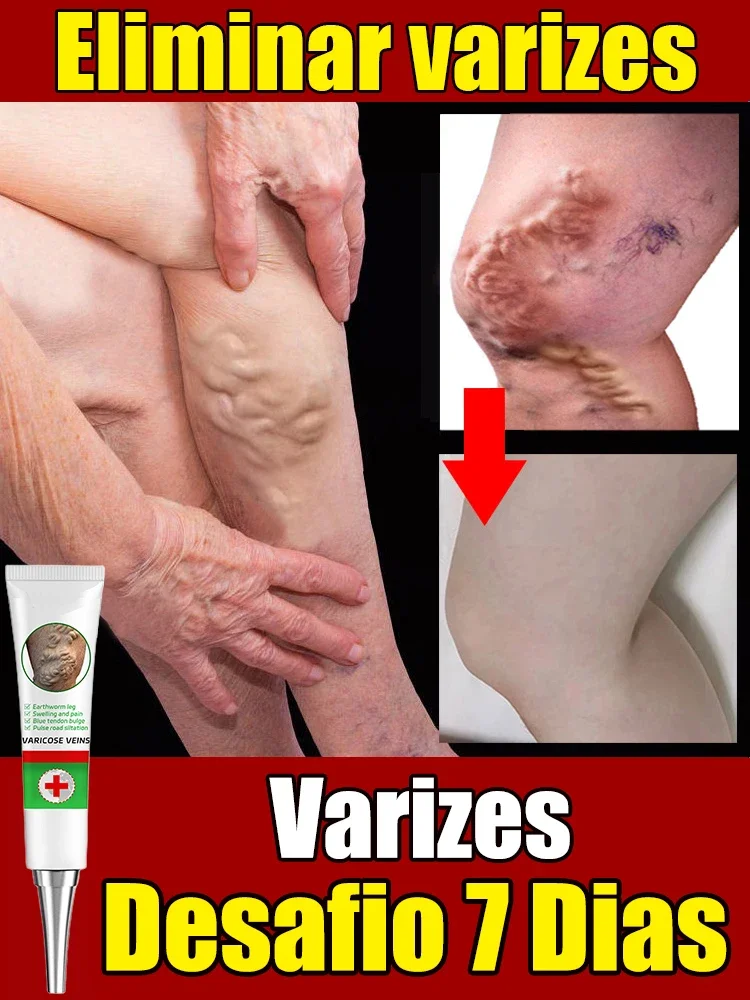 Effective Varicose Vein Relief Cream Ointment For Varicose Veins To Relieve Vasculitis Phlebitis Spider Pain Treatment  medical