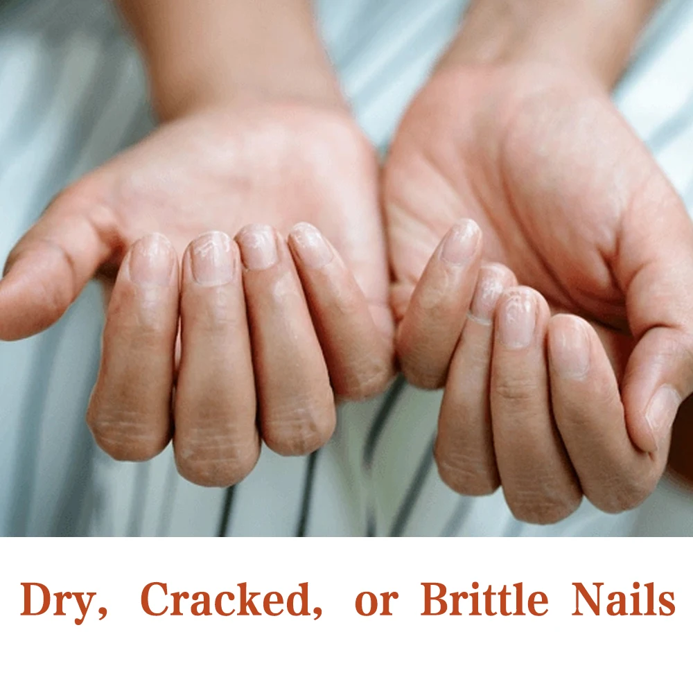 KODIES ジェルピンクネイル Strgenthener メイクオーバーリッジフィラーベースオイルケラチン爪の成長トリートメントポリッシュナチュラルドライリペア爪