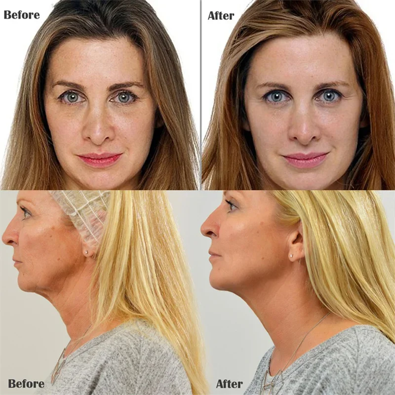 Lifting instantané du visage avec fil de collagène, déformable, élimine les fils solubles, ensemble de sérum 10000, remplisseur de visage absorbant, anti-âge, soins de la peau