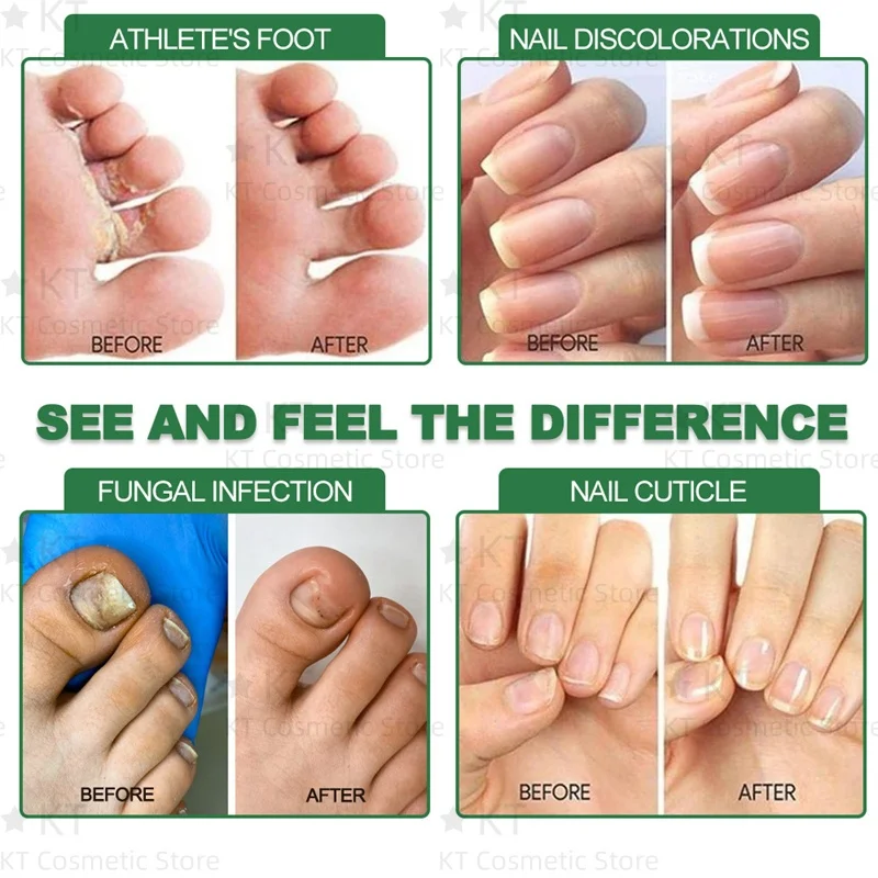7 日間真菌爪治療血清足の爪真菌除去修復ジェル抗感染爪周囲炎爪真菌症足の爪ケア