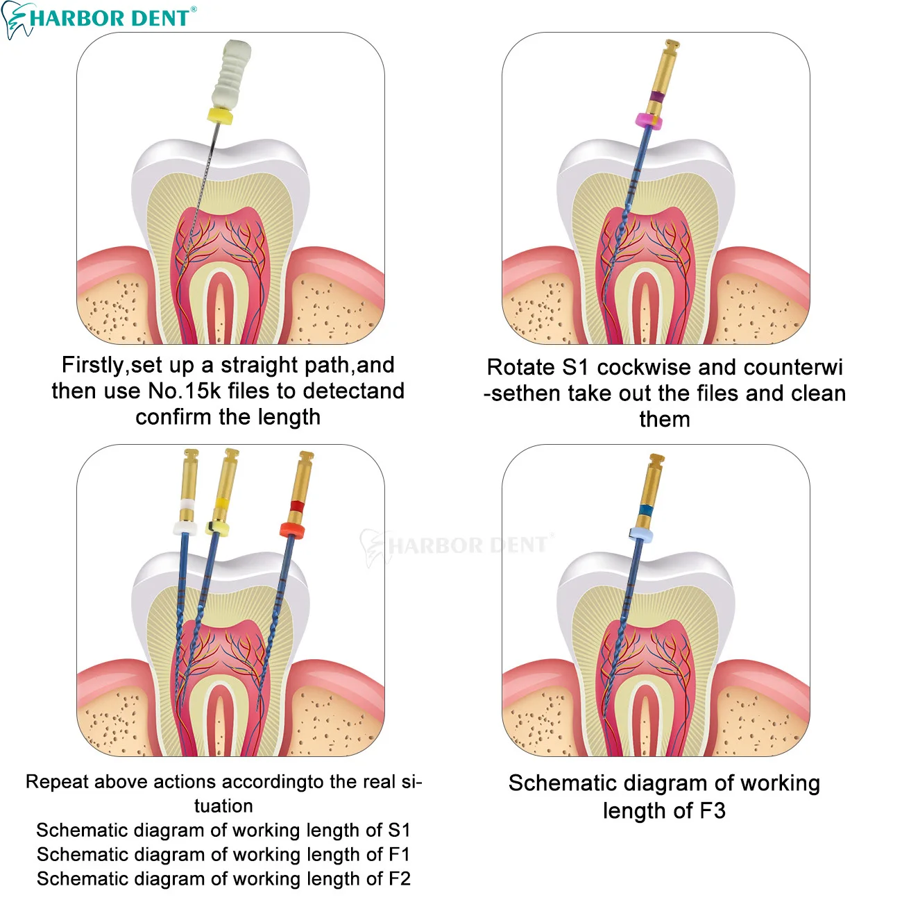 31 مللي متر الأسنان NiTi سوبر الملفات الذهب تنشيط الحرارة اللبية قناة الجذر الملفات طب الأسنان أداة 6 قطعة/صندوق