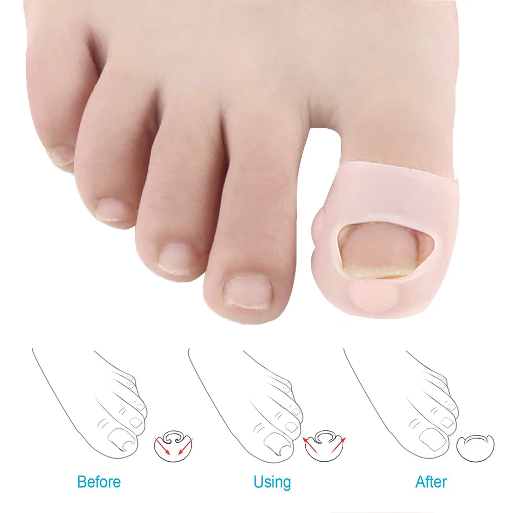 Pexmen 2/4/6Pcs Ingrown Toenail Corrector Sleeves Big Toe Nail Healing Care Protectors Paronychia Treatment Pedicure Tool