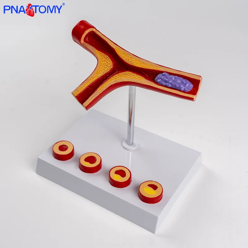 

Arterial Thrombus Model with 5 Components Vascular Occlusion Atherosclerotic Vascular Pathology