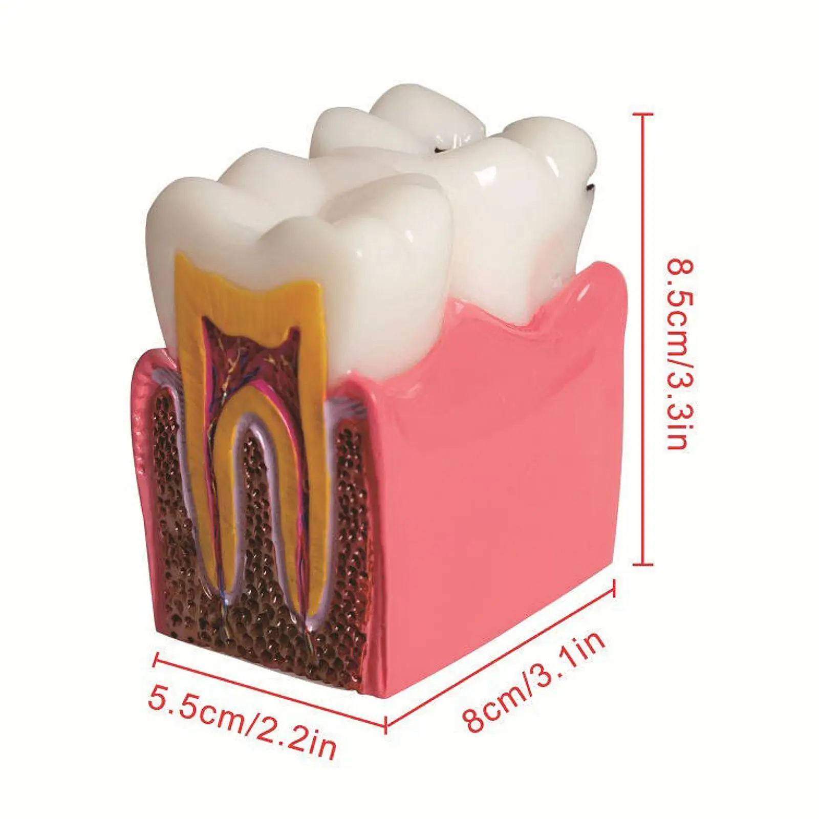 6 Times Caries Tooth Model Resin Caries Structure Detailed Teaching Aid Decay Tooth Comparative Study Model for Students Kids