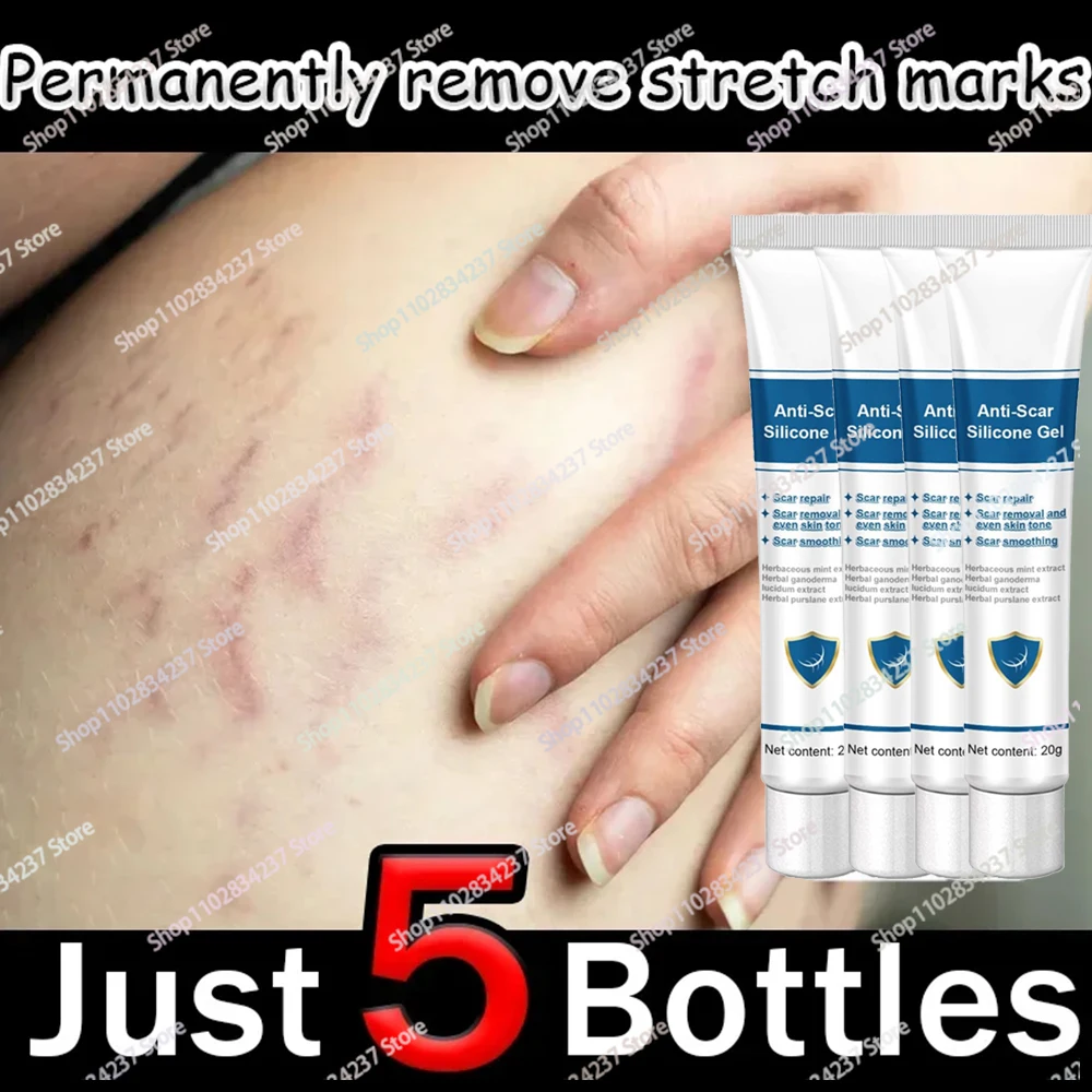 Stretch Mark Remover Permanent Stretch Mark Remover stretch marks remove scars