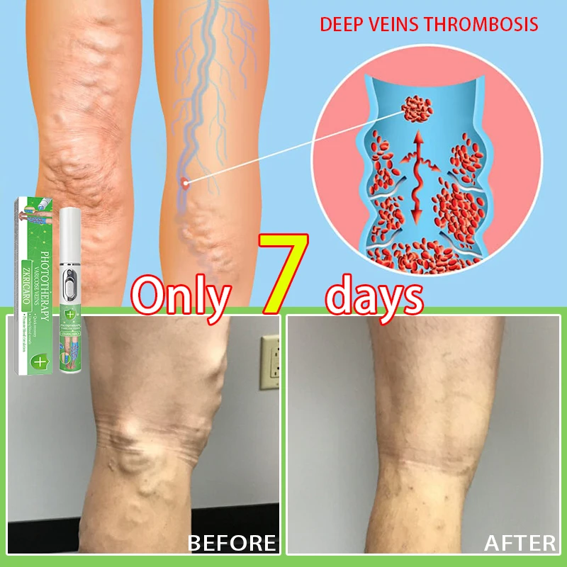 

Varicose vein treatment Laser relief for leg problems