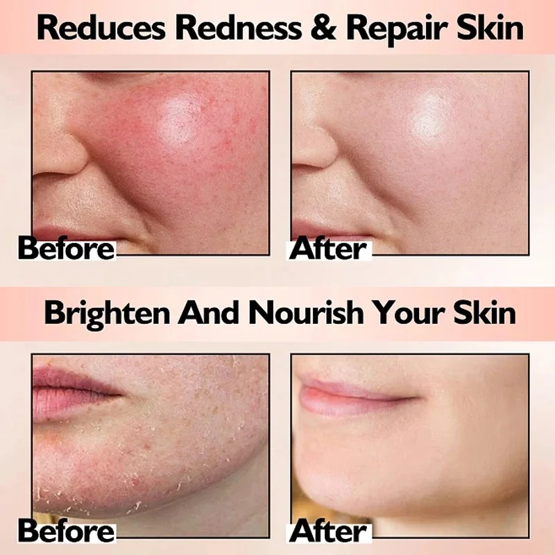 Facial Redness Repair Serum Against Redness Rosacea Spider Vein Treatment Sensitive Skin Shrink Pore Korean Face Skin Care Cream