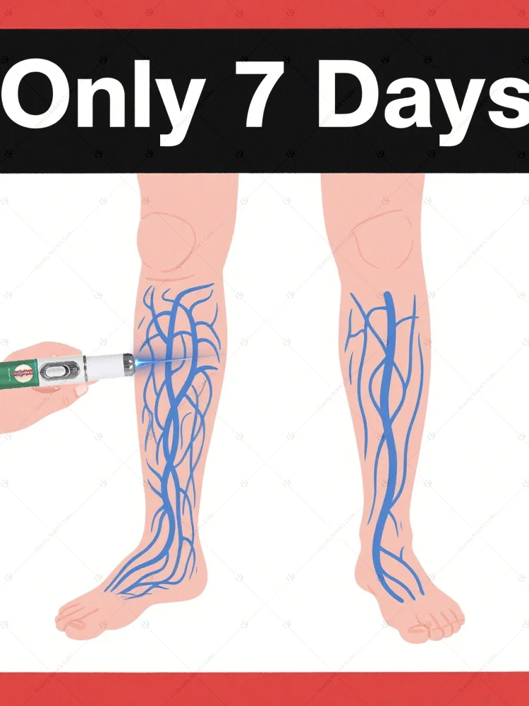 In 7 Days，Generation-2 Laser Says Goodbye To Spider Legs Varicose