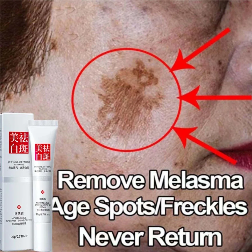 Improve Freckle Whiten Cream Effective Dullness Remove Dark Spot Melasma Fade Anti-pigmentation Brighten Face Skin Care