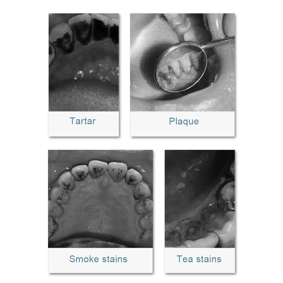 전기 초음파 치석 제거기, 치아 클리너, 치과 청소, 치아 미백 스케일러, 구강 관리