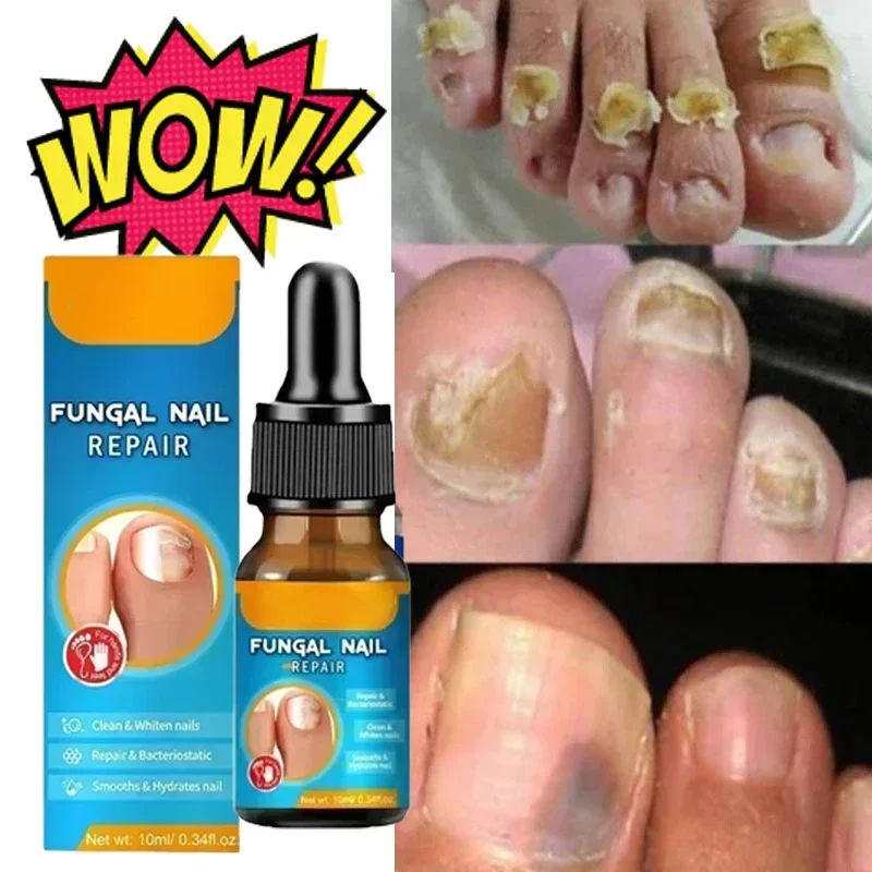 

Effective treatment of onychomycosis, removal of paronychia, anti oil fungus nail infection, care of toenail polish