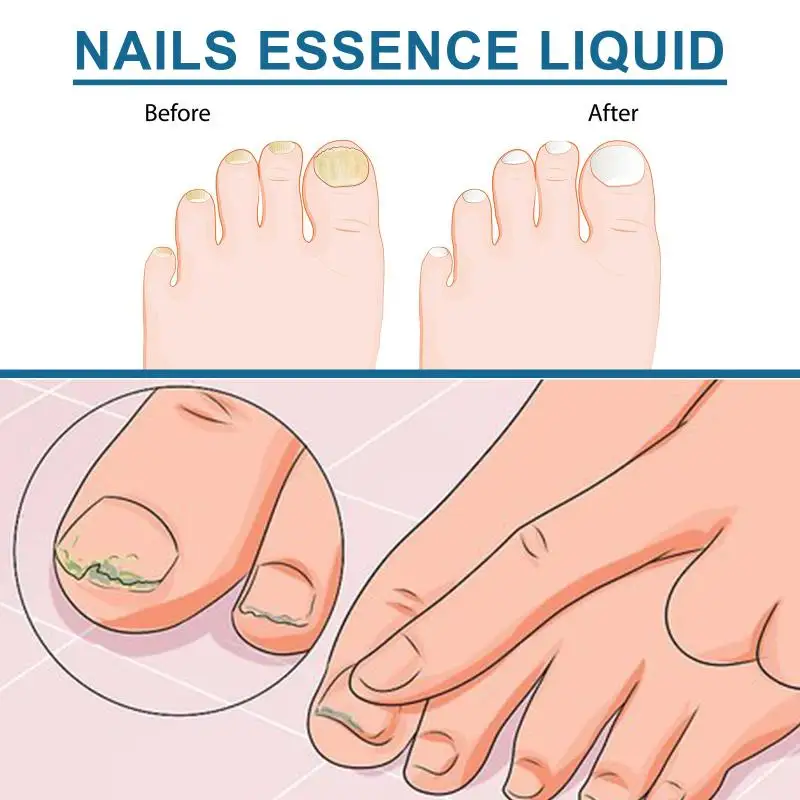 

Nail Care Essence Liquid Gentle Deep Cleansing Nourishing Hydrate Repair Damaged Nails Anti Infection Fungal Nails Care Oil