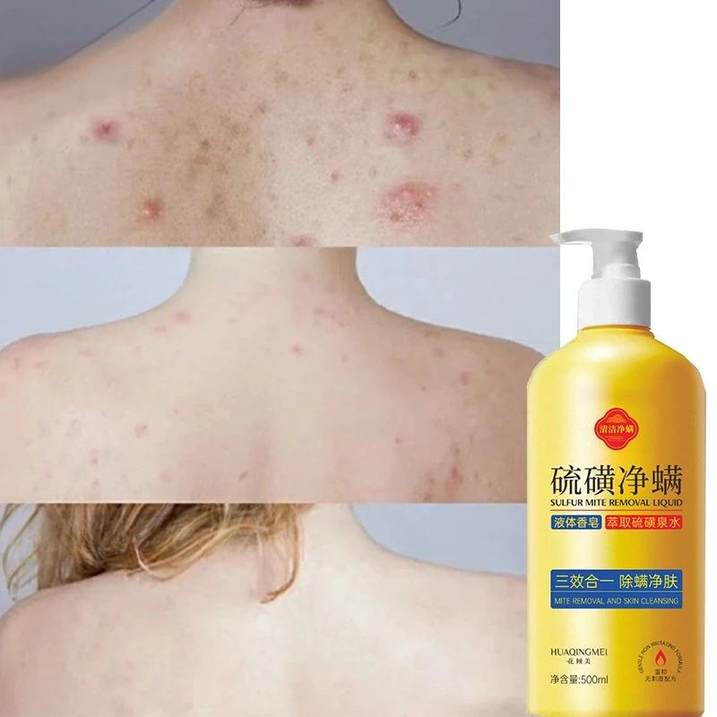 Sulfur Mite Removal Three and One Body Wash Shampoo Cleansing Gentle Oil Control Antibacterial Anti-dandruff Anti-itching