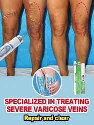 Laser therapy can improve medium-intensity varicose veins, effectively unblock and permanently eradicate them