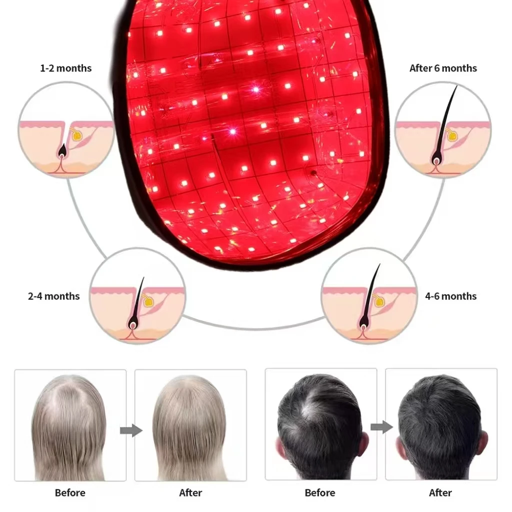 LED Red Light Therapy Hair Growth Cap Diode Laser Hat Helmet for Hair Regrowth Hair Loss Treatment