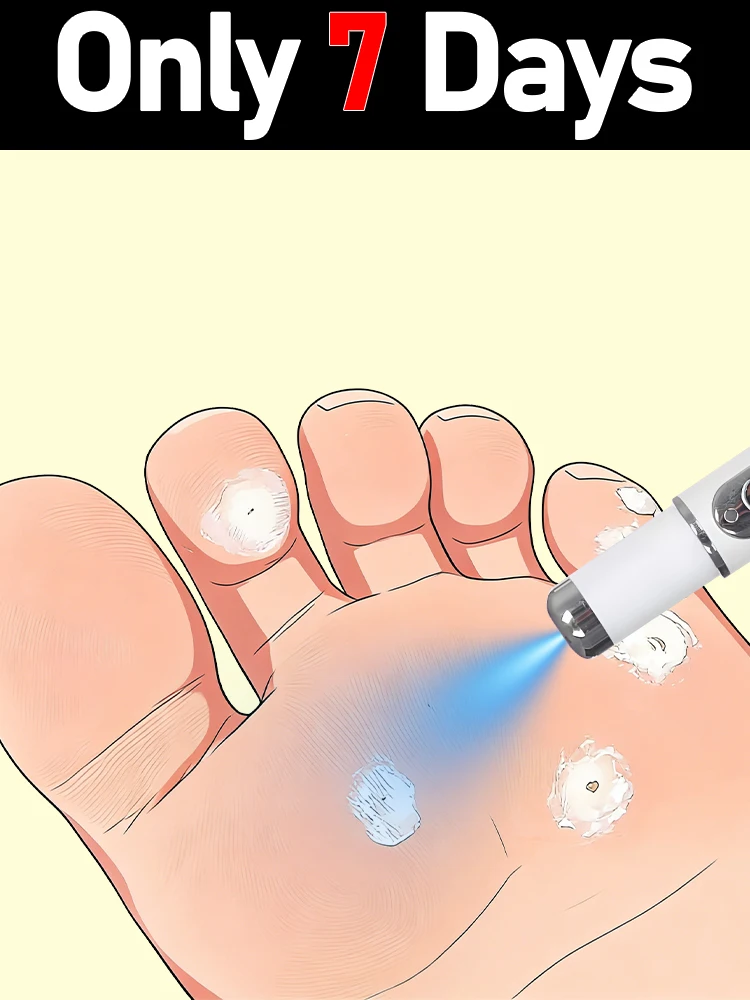 New generation wart removal pen, removes flat warts and filamentous warts on the neck and face, fleshy bump removal