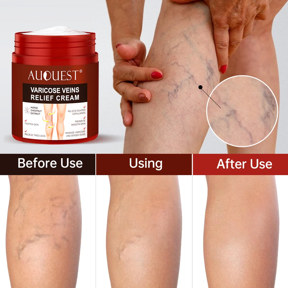 Effective Varicose Vein Relief Cream Removal Vasculitis Phlebitis Ointment Foot Legs Dilated Capillaries Treatment Body Care