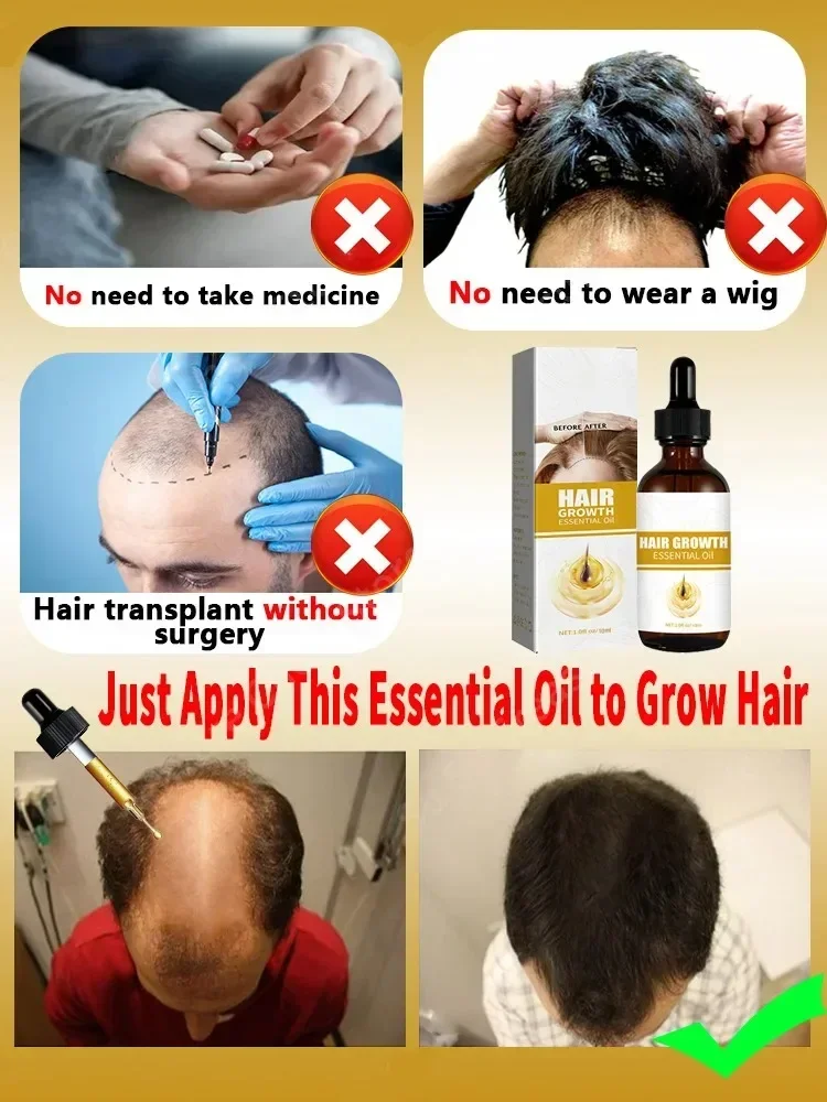 Hair Growth Essential Loss Regrowth Treatment เสริมสร้างเส้นผมบํารุงหนังศีรษะน้ําหนักเบาไม่เหนียวเหนอะหนะปรับปรุงการไหลเวียนของหนังศีรษะ