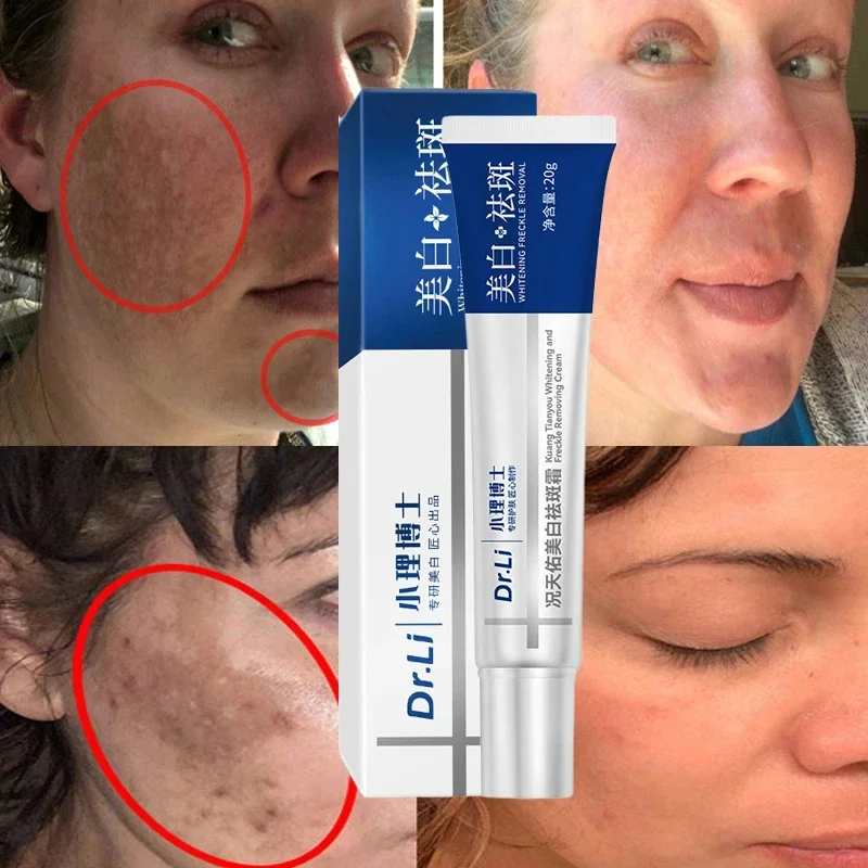 Effective Whitening Freckles Cream Remove Melasma Dark Spots Fade Pigmentation Moisturize Brighten Face Skin Care Product