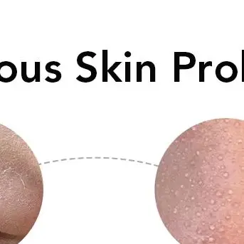 Ultrasone Huid Scrubber Elektrische Gezichtsreiniging Porie Diepe Reiniger Acne Comedondrukker Peeling Schop Schoonheid Machine