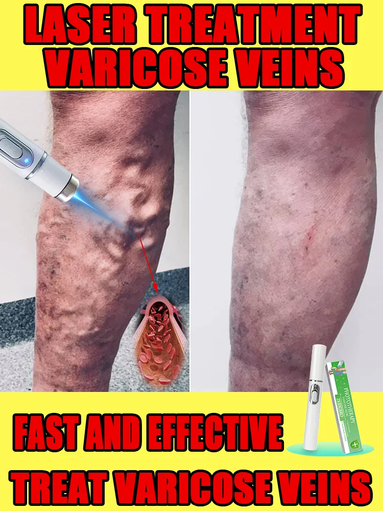 

Powerful Laser Therapy for Moderate Varicose Veins, Relieve Pain and Improve Circulation for Both Men and Women