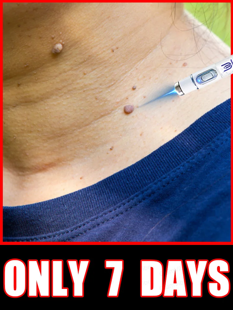 

2025 New Upgrade Blue Laser Solve Wart Tool