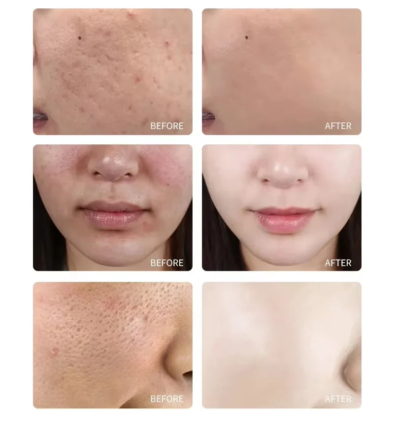 Acid Peeling Serum Chemical Exfoliant Peel For Remove Face Dark Skin Spots Whiten Lighten Melanin Peeling Solution Skin Peel