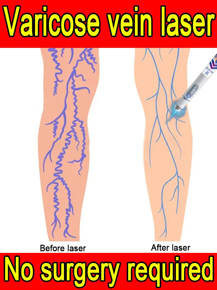 

Professional laser therapy: Eliminates spider leg pain and relieves vasculitis and phlebitis