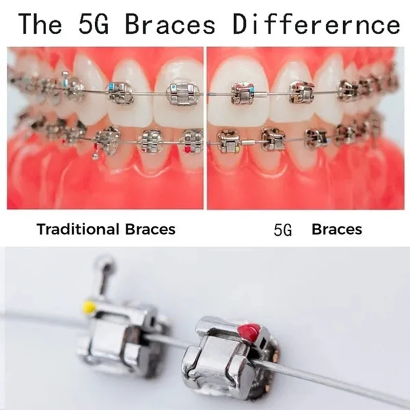 Dental Orthodontic Brackets Self-Ligating Brackets Roth/MBT 0.022 345Hooks Buccal Tubes Within 10PCS Tractions Hooks