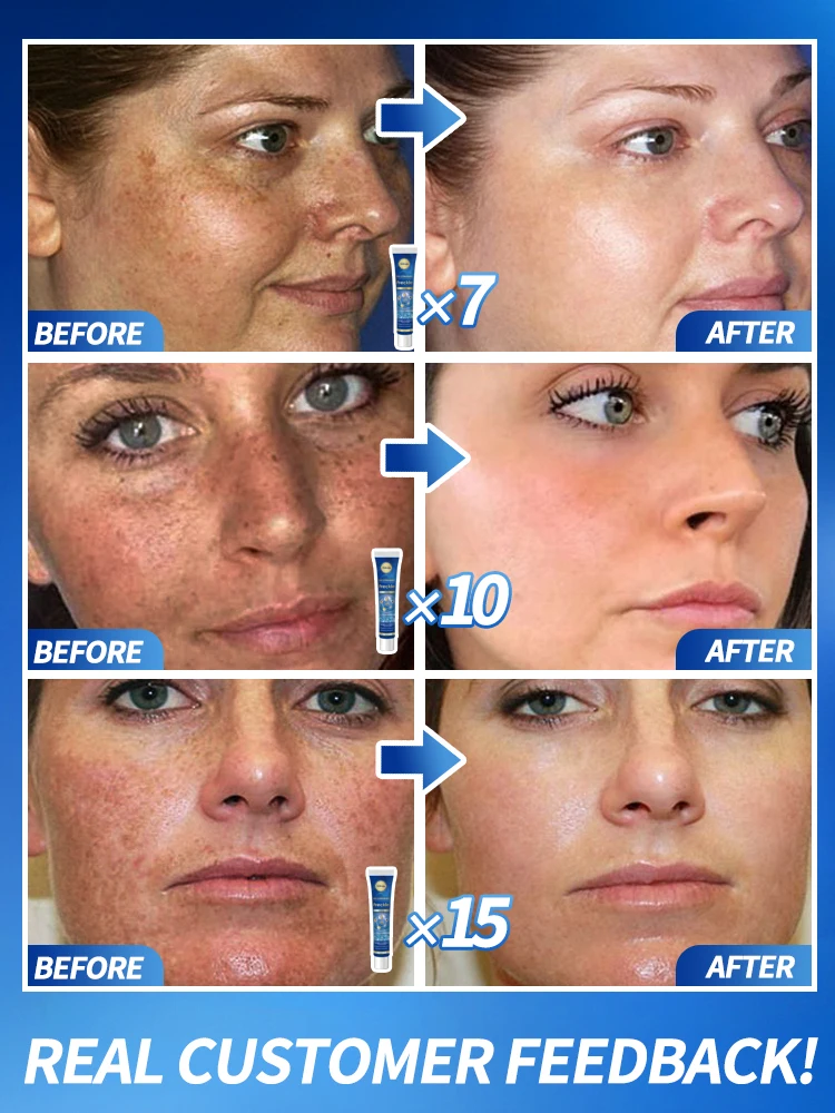 Remove freckles and whiten the skin, lighten and brighten facial dark spots