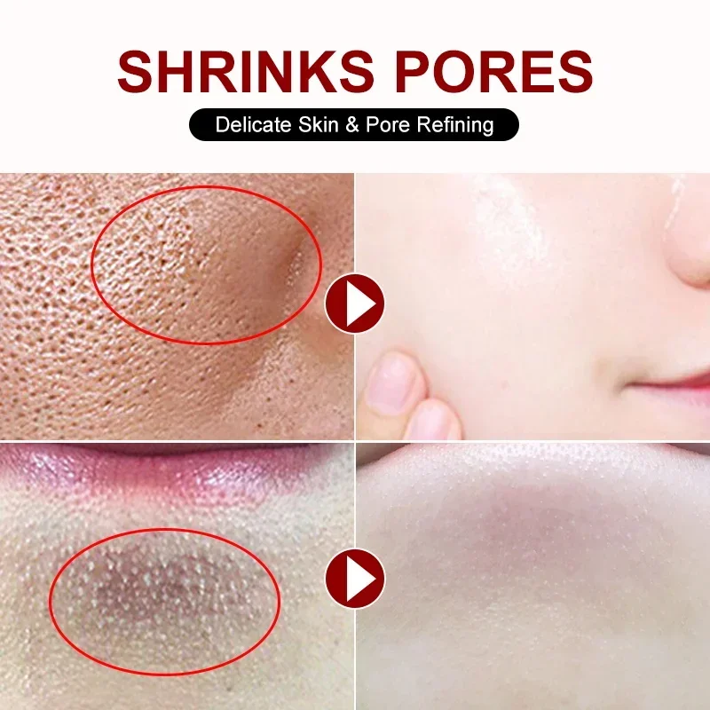 Crème de rétrécissement des pores à l'acide salicVAC, élimination rapide des grands pores, élimine les points noirs, resserre le visage, lisse la peau, produit de soin coréen