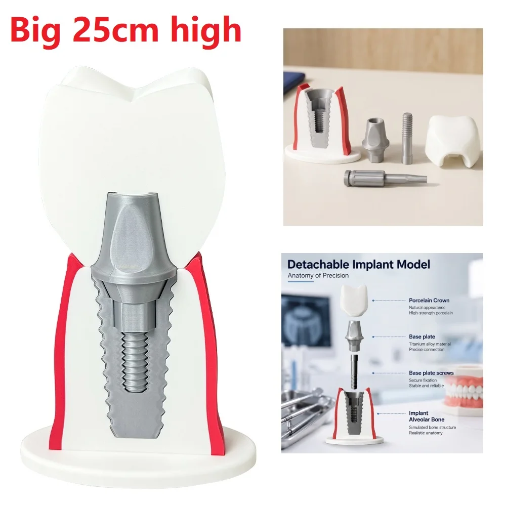 Large Dental Implant Study Model Removable Abutment Crown with Screwdriver Tool Implant Restoration Demonstration Teaching Model