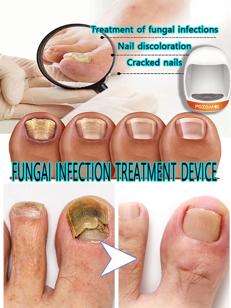 Fungal Nail Repair Fast Onychomycosis Fungus Nails