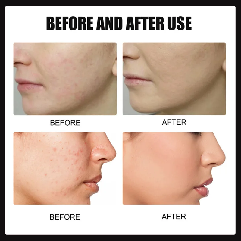 여드름, 블랙헤드, 거친 모공, 여드름 제거 및 여드름 흔적 완화에 도움을 주는 살리실산 에센스