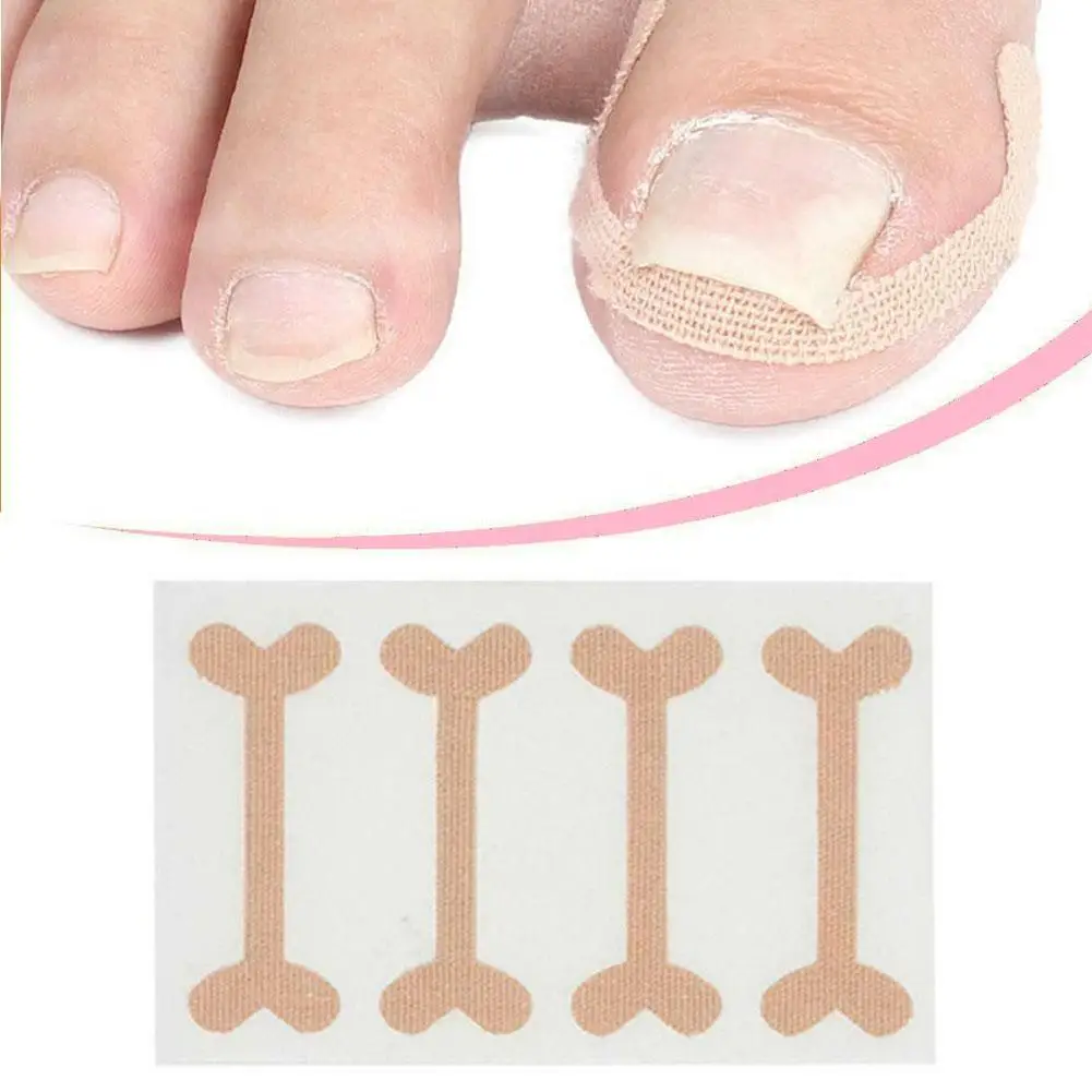 4pcs Nail Correction Stickers Toenail Patch Ingrown Toenail Corrector Patch Paronychia Treatment Recover Corrector Pedicure Tool