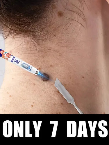 Bolígrafo de luz azul para resolver verrugas, herramientas para el cuidado de verrugas de gran oferta