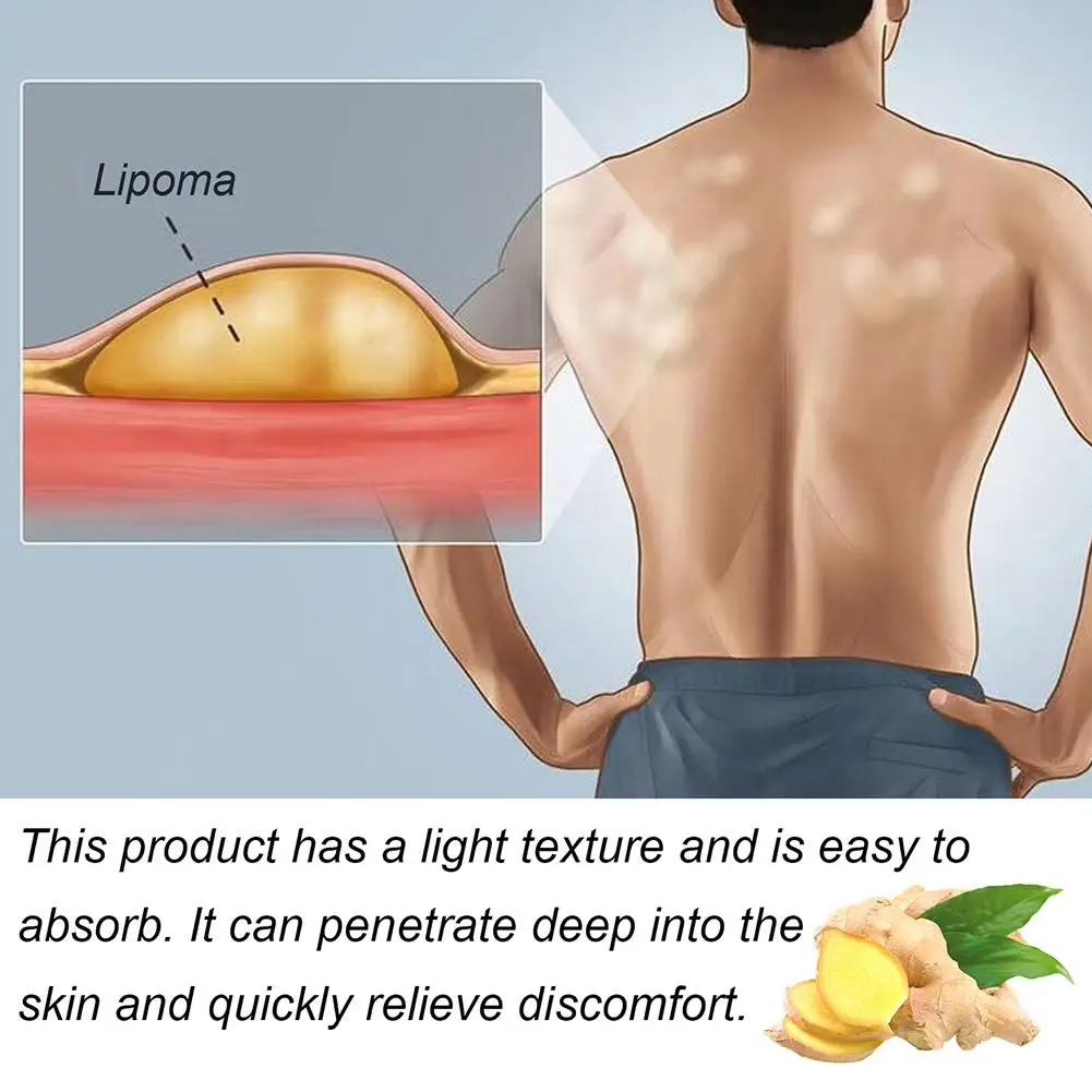 Lipoma Treatment Cream Effective Tightening The Skin Natural Herbal Scent Easy To Absorb Non-sensitive Cream Relieve Discomfort