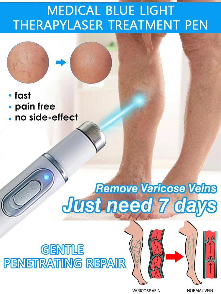 

Varicose vein blue light laser pointer, gentle and non-irritating, suitable for varicose veins and spider veins
