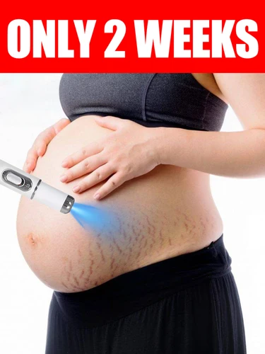 Herramienta de luz azul Striae Adiós a las estrías, herramientas para el cuidado de la piel materna