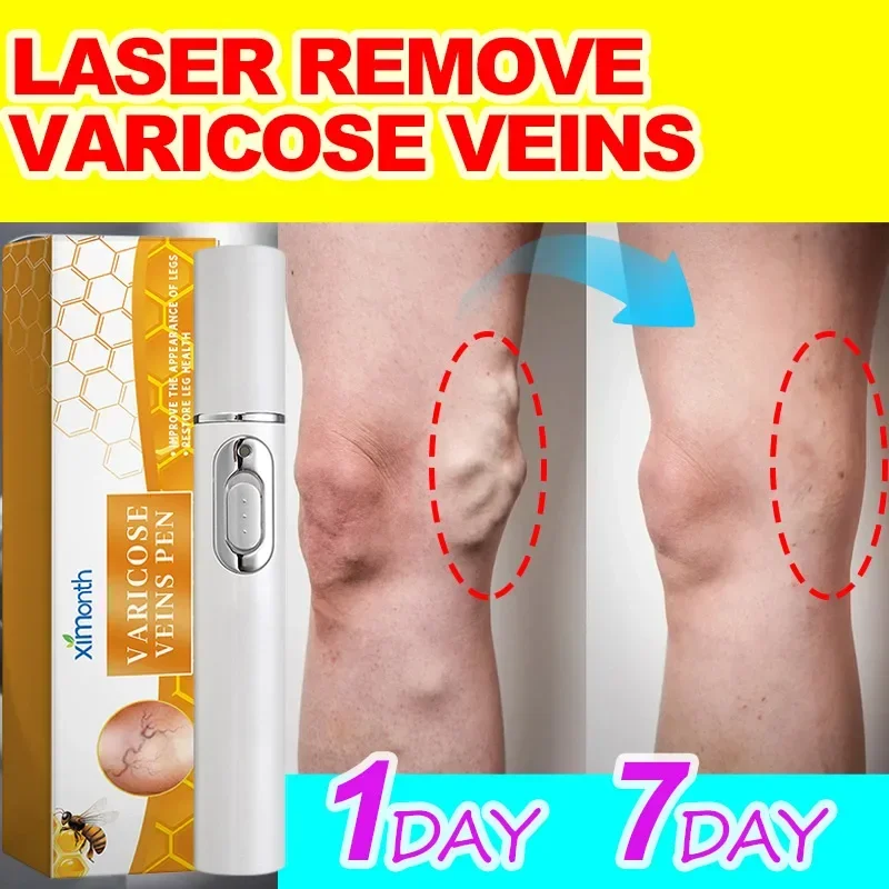 Thérapie au laser pour le traitement des varices, stylo à lumière bleue efficace pour les jambes de Charleroi, la vascularite dilatée, la phlébite, l'amélioration du surpoids de vache