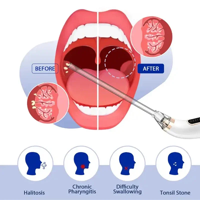 2024 New Electronic Tonsil Stone Remover Vacuum Removal Kit Oral Care Tonsil Stone Instant Suction Tools Improve 0ral Health