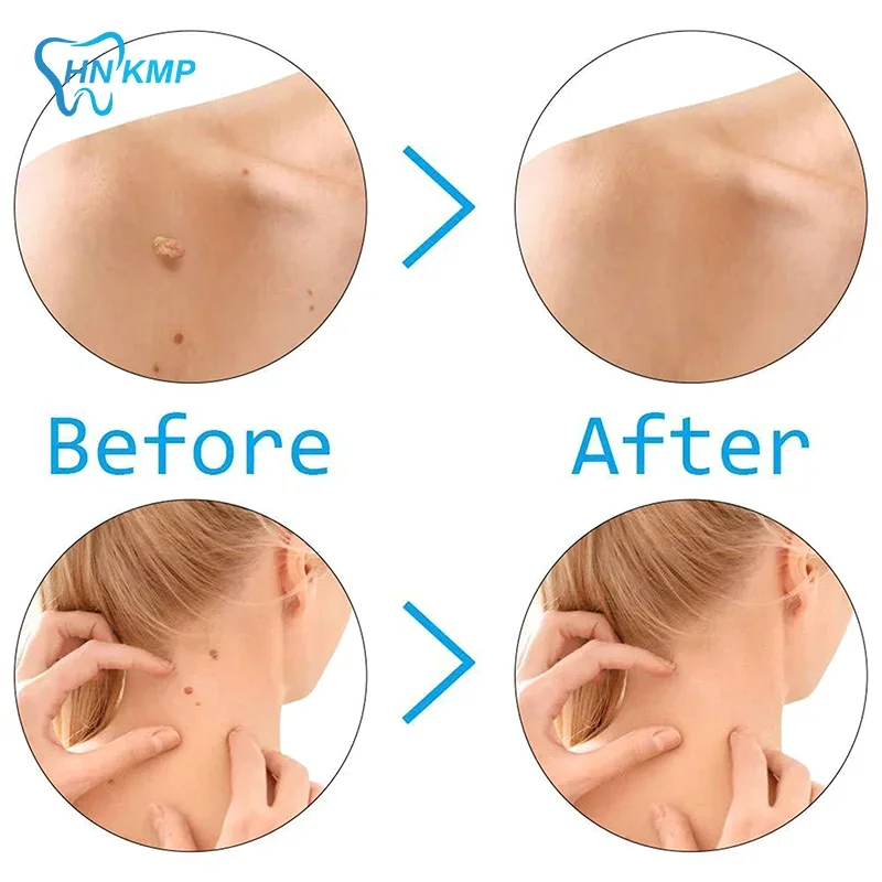 2mm-4mm Remove Skin Tag Shrink Rubber Ring 20pcs/box Non Toxic Health Beauty Skin Care Tools Tag Removal Mole Wart Removal 2