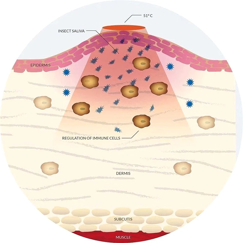 جهاز مضاد للحكة لعض البعوض الإلكتروني، قلم مضاد للحكة، جهاز مضاد للحكة، جهاز مضاد للحكة